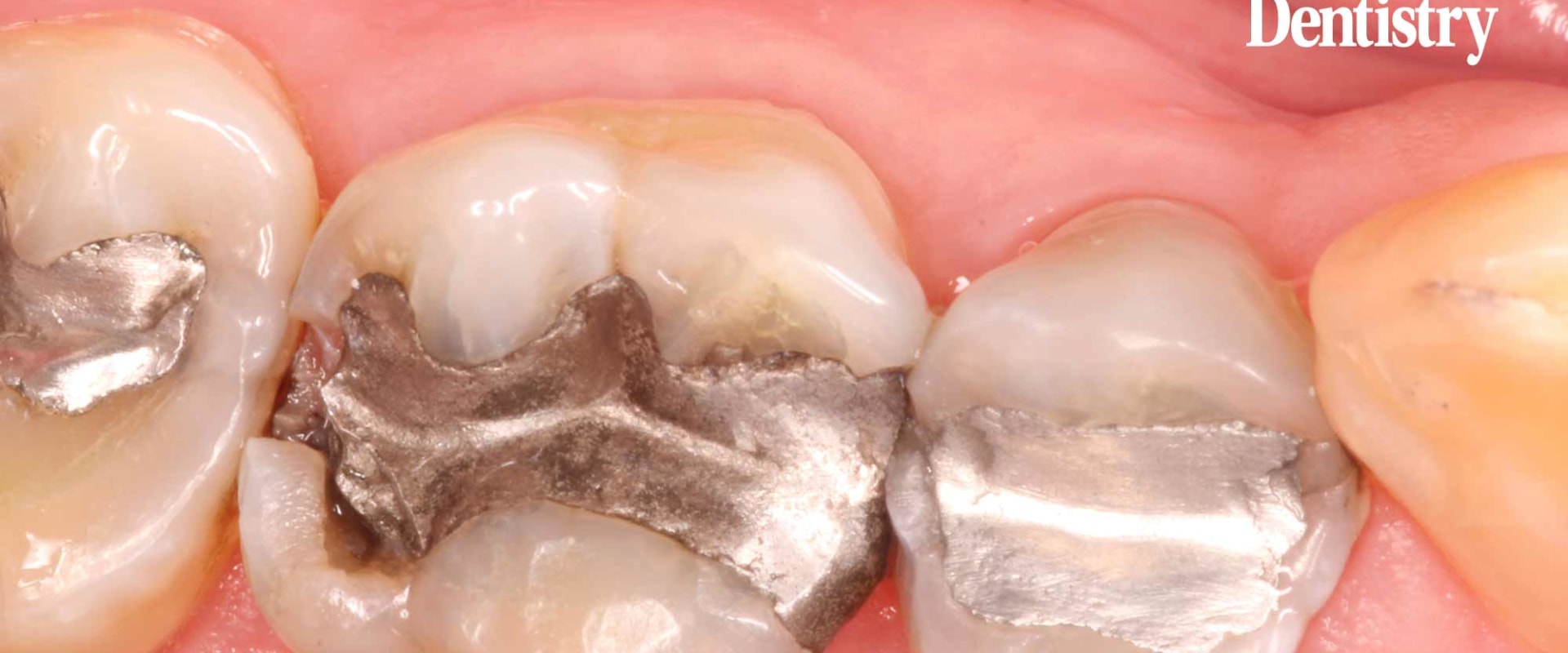 Which Material is the Most Commonly Used Dental Material for a Class