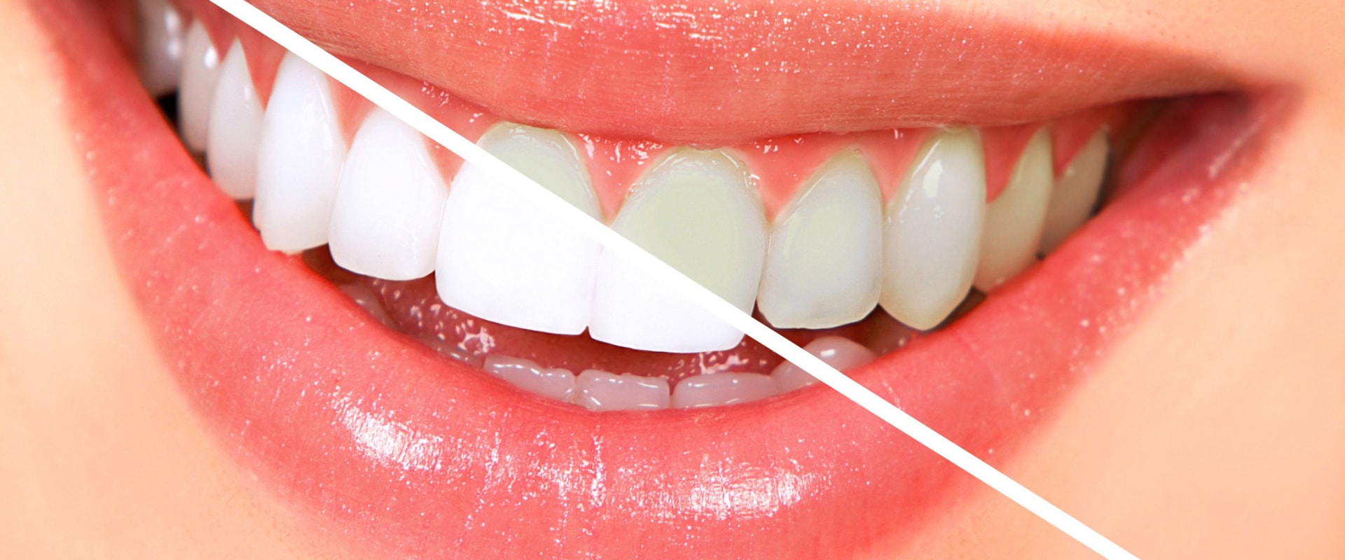 What is the Difference Between NHS and Private Dental Treatments?