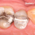 Which Material is the Most Commonly Used Dental Material for a Class Restoration?