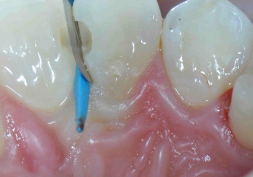 Which Material is the Most Commonly Used for Class III Dental Restorations?
