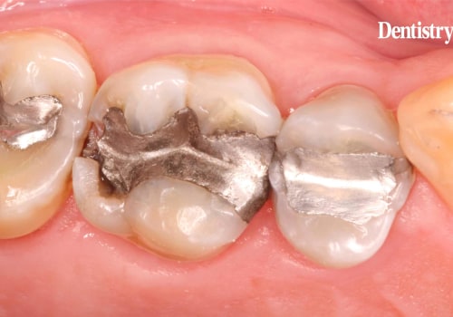 Which Material is the Most Commonly Used Dental Material for a Class Restoration?