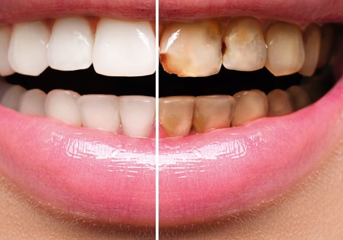 What is the Difference Between Preventive and Restorative Dental Treatments?